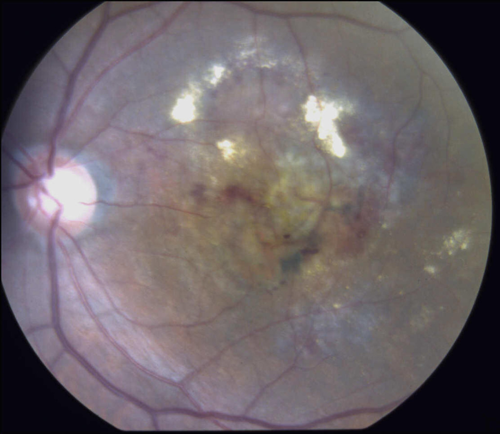 Macular Degeneration Hawaii Intravitreal injection Hawaii Eye