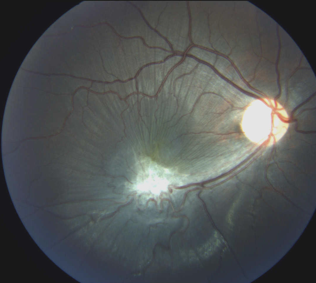 What is the prognosis for someone with macular pucker?