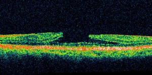 Normal Optical coherence tomography