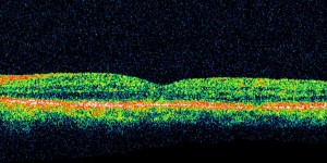 Abnormal Optical coherence tomography