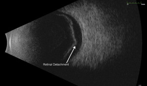 Retinal Detachment (arrow) imaged with ultrasound